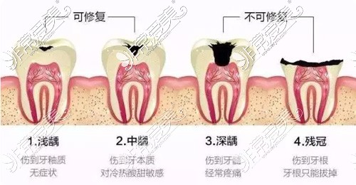 牙齿龋坏的程度展示