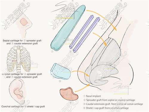 自体软骨隆鼻示意图