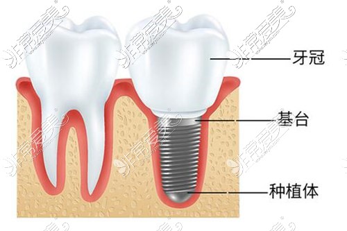 2022长沙种植牙价格一览表曝光 快看人工种牙一般多少钱一颗