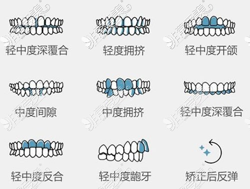哪些牙齿需要进行正畸改善治疗