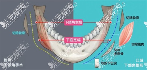 不同下颌角截骨术式