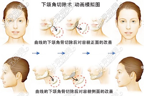 下颌角长曲线截骨术后对比卡通图