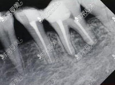 牙齿根管治疗改善照片