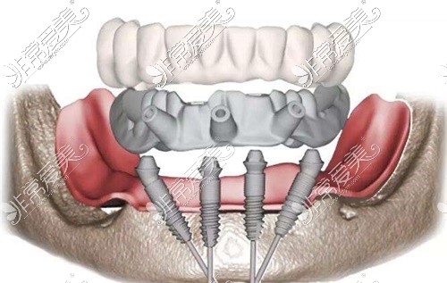 半固定种植牙示意图