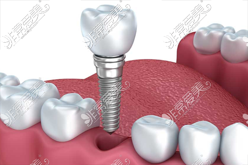种植牙示意图