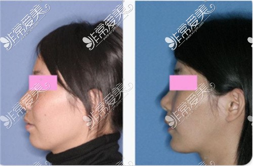 正颌手术后脸型改变图示