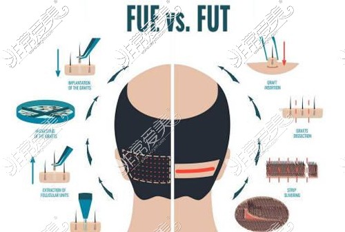 FUE和FUT植发技术对比