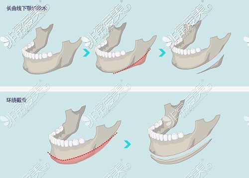 下颌角手术示意图