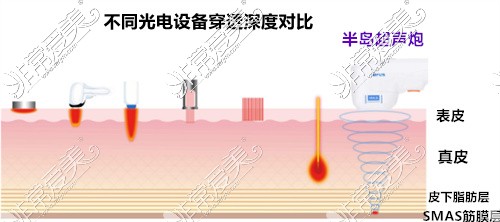 成都军大整形美容医院半岛超声炮原理图