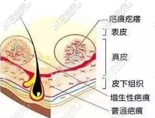 疤痕疙瘩刨面图