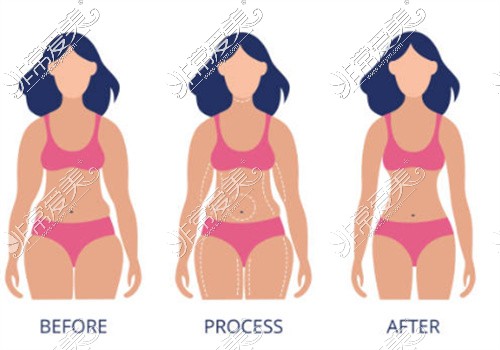 吸脂减肥过程卡通图