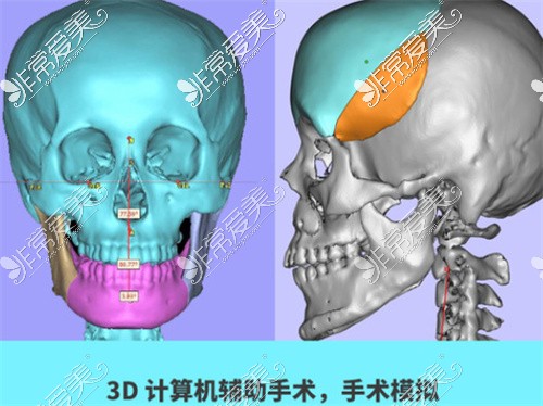 四川医院罗恩医生3D设计磨骨方案