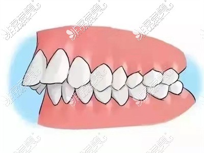 牙性龅牙前牙倾斜角度大
