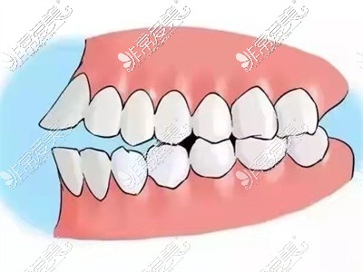 牙性龅牙矫正前牙齿过倾
