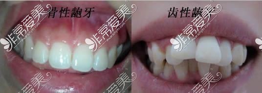 牙性龅牙和骨性龅牙对比照