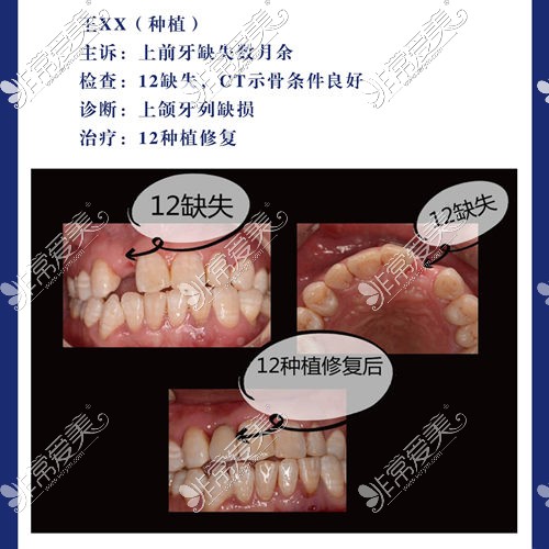 洛阳牙大夫口腔种植牙实例前后对比