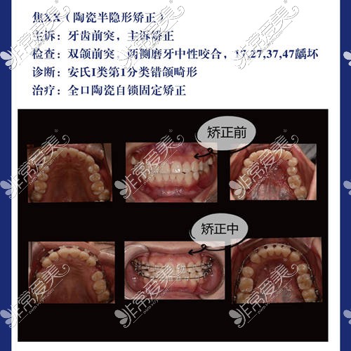 洛阳牙大夫口腔牙齿矫正实例前后对比