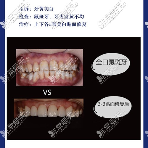 洛阳牙大夫口腔牙贴面实例前后对比