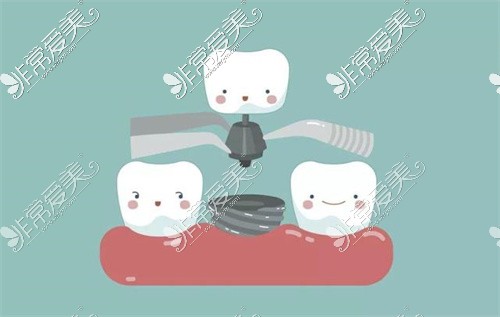 德阳牙齿种植卡通图