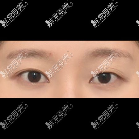 韩国icon双眼皮整形术前照