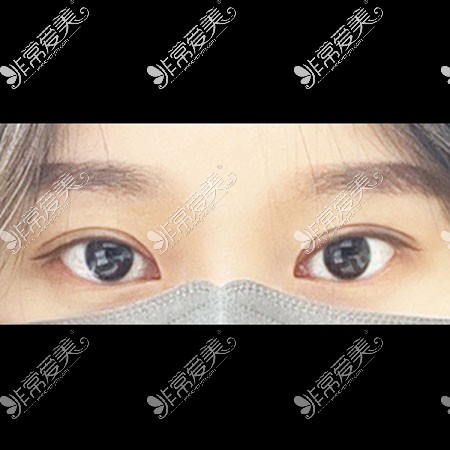韩国icon双眼皮整形手术图片