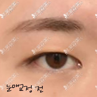 韩国icon整形双眼皮术前照