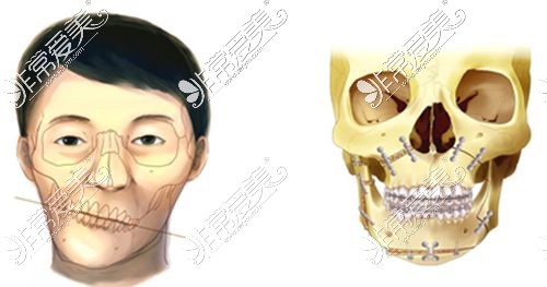 沈阳正颌手术谁做的好?求推荐正颌手术做的好的医生名单!