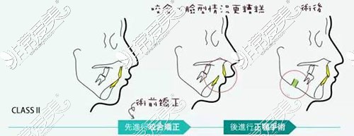 正畸正頜先后順序