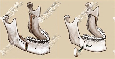 单颌手术示意图