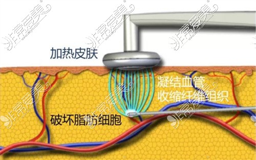 成都蘭柏羽美容醫(yī)院鉆石脂雕圖