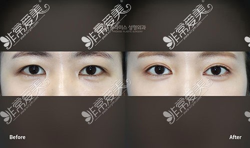 韩国普拉美斯双眼皮手术对比照