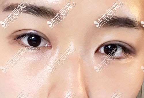 韩国yellow整形双眼皮术后14天