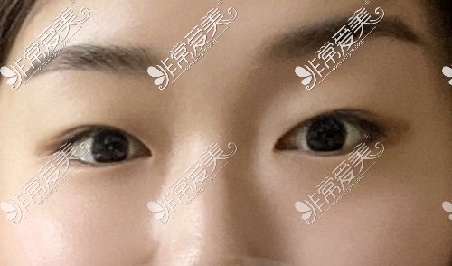 韩国yellow整形做眼睛手术前