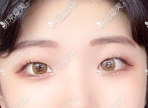 韩国yellow整形双眼皮术前照