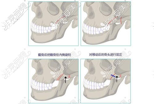 贵阳颧骨手术多少钱？哪家医院能做颧骨手术呢