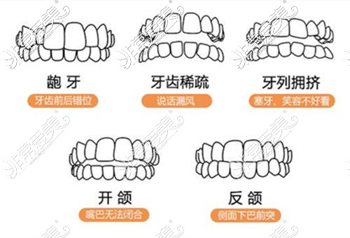 需要矫正的牙齿