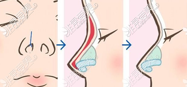 鼻假体取出示意图