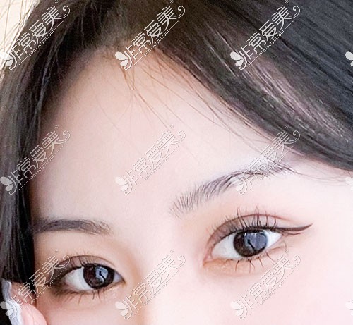 韩国yellow官方双眼皮术后60天照片