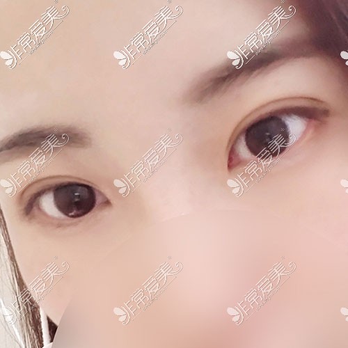 韩国双眼皮整形术后14天