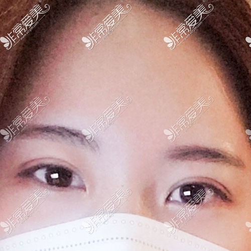 韩国yellow整形双眼皮图片