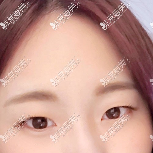 韩国yellow整形单眼皮照片
