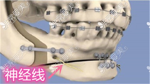 四川华西医院李继华医生磨骨示意图