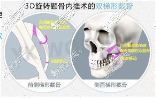 3D旋转式颧骨内推手术动画图