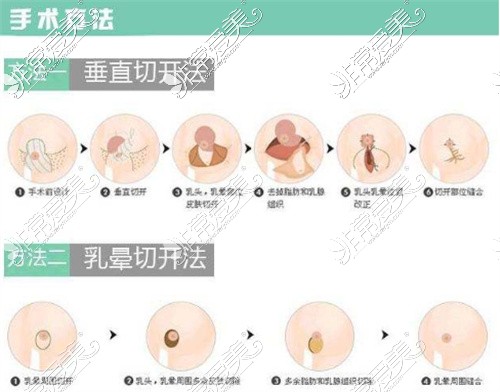 成都画美整形赵敬国博士手术方式