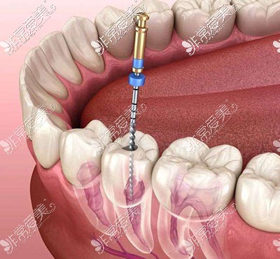 牙齿根管治疗图示