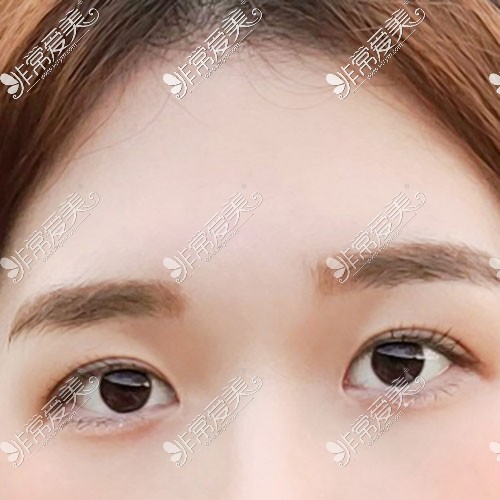 韩国yellow双眼皮整形图片