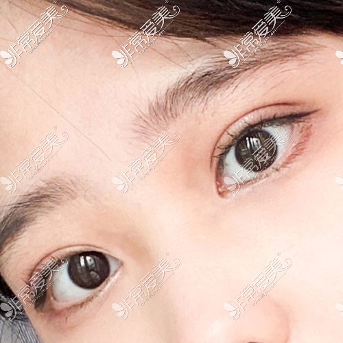韩国yellow双眼皮术后14天