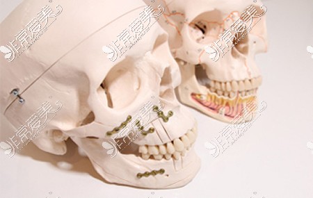 正颌手术骨骼宣传图
