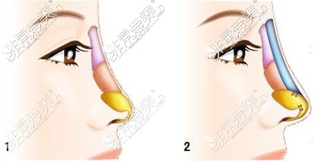 隆鼻假体放置位置图示