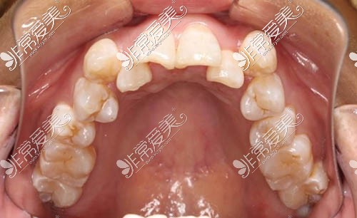 需要矫正的牙齿情况